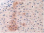 DAB staining on IHC-P; Samples: Human Liver Cancer Tissue