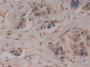 DAB staining on IHC-P; Samples: Human Breast cancer Tissue; Primary Ab: 10µg/ml Rabbit Anti-Human CASP8 Antibody Second Ab: 2µg/mL HRP-Linked Caprine Anti-Rabbit IgG Polyclonal Antibody