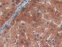 DAB staining on IHC-P; Samples: Human Liver cancer Tissue; Primary Ab: 20µg/ml Rabbit Anti-Human PYGL Antibody Second Ab: 2µg/mL HRP-Linked Caprine Anti-Rabbit IgG Polyclonal Antibody