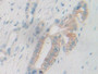 DAB staining on IHC-P; Samples: Human Bile duct cancer Tissue; Primary Ab: 10µg/ml Rabbit Anti-Human PYGB Antibody Second Ab: 2µg/mL HRP-Linked Caprine Anti-Rabbit IgG Polyclonal Antibody