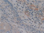 DAB staining on IHC-P; Samples: Human Skin cancer Tissue; Primary Ab: 10µg/ml Rabbit Anti-Human NOS2 Antibody Second Ab: 2µg/mL HRP-Linked Caprine Anti-Rabbit IgG Polyclonal Antibody