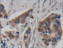 DAB staining on IHC-P; Samples: Human Breast cancer Tissue; Primary Ab: 10µg/ml Rabbit Anti-Human CRH Antibody Second Ab: 2µg/mL HRP-Linked Caprine Anti-Rabbit IgG Polyclonal Antibody