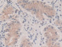 DAB staining on IHC-P; Samples: Human Stomach cancer Tissue)