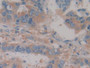 DAB staining on IHC-P; Samples: Human Breast cancer Tissue; Primary Ab: 10µg/ml Rabbit Anti-Human Hpt Antibody Second Ab: 2µg/mL HRP-Linked Caprine Anti-Rabbit IgG Polyclonal Antibody