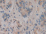 DAB staining on IHC-P; Samples: Human Prostate cancer Tissue; Primary Ab: 10µg/ml Rabbit Anti-Human Hpt Antibody Second Ab: 2µg/mL HRP-Linked Caprine Anti-Rabbit IgG Polyclonal Antibody