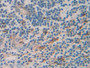 DAB staining on IHC-P; Samples: Human Prostate cancer Tissue; Primary Ab: 20µg/ml Rabbit Anti-Human TNFRSF12A Antibody Second Ab: 2µg/mL HRP-Linked Caprine Anti-Rabbit IgG Polyclonal Antibody