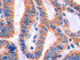 DAB staining on IHC-P; Samples: Human Thyroid cancer Tissue;  Primary Ab: 20µg/ml Rabbit Anti-Human 