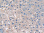 DAB staining on IHC-P; Samples：Human Liver Cancer Tissue.