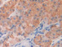 DAB staining on IHC-P; Samples: Human Stomach cancer Tissue)