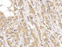 DAB staining on IHC-P; Samples: Human Breast cancer Tissue; Primary Ab: 10µg/ml Rabbit Anti-Human FOXP1 Antibody Second Ab: 2µg/mL HRP-Linked Caprine Anti-Rabbit IgG Polyclonal Antibody