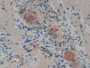 DAB staining on IHC-P; Samples: Human Stomach cancer Tissue)