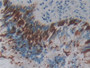 DAB staining on IHC-P; Samples: Human Lung cancer Tissue; Primary Ab: 10µg/ml Rabbit Anti-Human PDCD1 Antibody Second Ab: 2µg/mL HRP-Linked Caprine Anti-Rabbit IgG Polyclonal Antibody