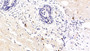DAB staining on IHC-P; Samples: Human Stomach Cancer Tissue