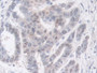 DAB staining on IHC-P; Samples: Human Liver cancer Tissue;  Primary Ab: 30µg/ml Rabbit Anti-Human PT