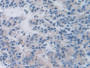 DAB staining on IHC-P; Samples: Human Prostate cancer Tissue; Primary Ab: 10µg/ml Rabbit Anti-Human TTR Antibody Second Ab: 2µg/mL HRP-Linked Caprine Anti-Rabbit IgG Polyclonal Antibody