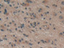 DAB staining on IHC-P; Samples: Human Glioma Tissue; Primary Ab: 5µg/ml Rabbit Anti-Human dSIP Antibody Second Ab: 2µg/mL HRP-Linked Caprine Anti-Rabbit IgG Polyclonal Antibody