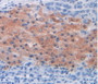 Figure. DAB staining on IHC-P; Samples: Human Liver Cancer Tissue.