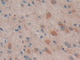 DAB staining on IHC-P; Samples: Human Glioma Tissue; Primary Ab: 10µg/ml Rabbit Anti-Human PTGS2 Antibody Second Ab: 2µg/mL HRP-Linked Caprine Anti-Rabbit IgG Polyclonal Antibody