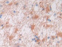 DAB staining on IHC-P; Samples: Human Glioma Tissue; Primary Ab: 30µg/ml Rabbit Anti-Human vWA3A Antibody Second Ab: 2µg/mL HRP-Linked Caprine Anti-Rabbit IgG Polyclonal Antibody