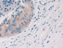 DAB staining on IHC-P; Samples: Mouse Prostate cancer Tissue; Primary Ab: 30µg/ml Rabbit Anti-Mouse Slit2 Antibody Second Ab: 2µg/mL HRP-Linked Caprine Anti-Rabbit IgG Polyclonal Antibody
