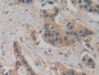 DAB staining on IHC-P; Samples: Human Breast cancer Tissue; Primary Ab: 10µg/ml Rabbit Anti-Human Slit2 Antibody Second Ab: 2µg/mL HRP-Linked Caprine Anti-Rabbit IgG Polyclonal Antibody