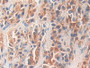 DAB staining on IHC-P; Samples: Human Prostate cancer Tissue; Primary Ab: 10µg/ml Rabbit Anti-Human KLK11 Antibody Second Ab: 2µg/mL HRP-Linked Caprine Anti-Rabbit IgG Polyclonal Antibody