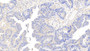 DAB staining on IHC-P; Samples: Human Colorectal cancer Tissue;  Primary Ab: 20μg/ml Rabbit Anti-Human CAM Antibody Second Ab: 2µg/mL HRP-Linked Caprine Anti-Rabbit IgG Polyclonal Antibody 