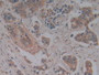 Figure. DAB staining on IHC-P; Samples: Human Breast Cancer Tissue.