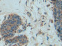 DAB staining on IHC-P; Samples: Human Mammary gland Tissue; Primary Ab: 20µg/ml Rabbit Anti-Human PDGFBB Antibody Second Ab: 2µg/mL HRP-Linked Caprine Anti-Rabbit IgG Polyclonal Antibody