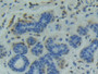 DAB staining on IHC-P; Samples: Human Breast cancer Tissue