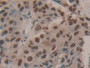 DAB staining on IHC-P; Samples: Human Breast cancer Tissue; Primary Ab: 10µg/ml Rabbit Anti-Human HDGF Antibody Second Ab: 2µg/mL HRP-Linked Caprine Anti-Rabbit IgG Polyclonal Antibody