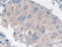 DAB staining on IHC-P; Samples: Human Breast cancer Tissue; Primary Ab: 10µg/ml Rabbit Anti-Human TACR2 Antibody Second Ab: 2µg/mL HRP-Linked Caprine Anti-Rabbit IgG Polyclonal Antibody