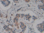 DAB staining on IHC-P; Samples: Human Breast cancer Tissue; Primary Ab: 10µg/ml Rabbit Anti-Human TAFI Antibody Second Ab: 2µg/mL HRP-Linked Caprine Anti-Rabbit IgG Polyclonal Antibody