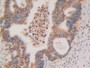 DAB staining on IHC-P; Samples: Human Rectum Cancer Tissue.