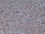 DAB staining on IHC-P; Samples: Human Prostate Gland Cancer Tissue