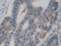 DAB staining on IHC-P; Samples: Human Colorectal cancer Tissue; Primary Ab: 10µg/ml Rabbit Anti-Human PKM2 Antibody Second Ab: 2µg/mL HRP-Linked Caprine Anti-Rabbit IgG Polyclonal Antibody