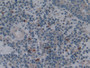 DAB staining on IHC-P; Samples: Human Skin cancer Tissue; Primary Ab: 10µg/ml Rabbit Anti-Human HO1 Antibody Second Ab: 2µg/mL HRP-Linked Caprine Anti-Rabbit IgG Polyclonal Antibody