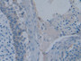 DAB staining on IHC-P; Samples: Human Skin cancer Tissue