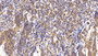 DAB staining on IHC-P; Sample: Human Stomach cancer Tissue; Primary Ab: 20ug/ml Rabbit Anti-Human LIFR Antibody Second Ab: 2µg/mL HRP-Linked Caprine Anti-Rabbit IgG Polyclonal Antibody