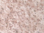 DAB staining on IHC-P; Samples: Human Glioma Tissue