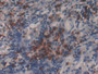 DAB staining on IHC-P; Samples: Human Lung cancer Tissue; Primary Ab: 20µg/ml Rabbit Anti-Human MMP9 Antibody Second Ab: 2µg/mL HRP-Linked Caprine Anti-Rabbit IgG Polyclonal Antibody