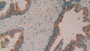 DAB staining on IHC-P; Samples: Human Prostate Gland Tissue.