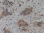 DAB staining on IHC-P; Samples: Human Breast cancer Tissue; Primary Ab: 10µg/ml Rabbit Anti-Human KRT9 Antibody Second Ab: 2µg/mL HRP-Linked Caprine Anti-Rabbit IgG Polyclonal Antibody