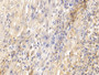 DAB staining on IHC-P; Samples: Human Lymphoma Tissue; Primary Ab: 10ug/ml Rabbit Anti-Human ICAM1 Antibody Second Ab: 2µg/mL HRP-Linked Caprine Anti-Rabbit IgG Polyclonal Antibody