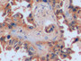 DAB staining on IHC-P; Samples: Human Lung cancer Tissue; Primary Ab: 10µg/ml Rabbit Anti-Human ICAM1 Antibody Second Ab: 2µg/mL HRP-Linked Caprine Anti-Rabbit IgG Polyclonal Antibody