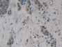 DAB staining on IHC-P; Samples: Human Breast cancer Tissue; Primary Ab: 10µg/ml Rabbit Anti-Human NSE Antibody Second Ab: 2µg/mL HRP-Linked Caprine Anti-Rabbit IgG Polyclonal Antibody