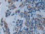 DAB staining on IHC-P; Samples: Human Breast cancer Tissue; Primary Ab: 20µg/ml Rabbit Anti-Human PKR Antibody Second Ab: 2µg/mL HRP-Linked Caprine Anti-Rabbit IgG Polyclonal Antibody