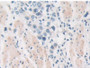 DAB staining on IHC-P; Samples: Human Stomach cancer Tissue; Primary Ab: 10µg/ml Rabbit Anti-Human PKD2 Antibody Second Ab: 2µg/mL HRP-Linked Caprine Anti-Rabbit IgG Polyclonal Antibody