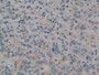 DAB staining on IHC-P; Samples: Human Prostate cancer Tissue; Primary Ab: 10µg/ml Rabbit Anti-Human PKD1 Antibody Second Ab: 2µg/mL HRP-Linked Caprine Anti-Rabbit IgG Polyclonal Antibody