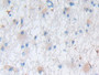 DAB staining on IHC-P; Samples: Human Glioma Tissue; Primary Ab: 30µg/ml Rabbit Anti-Human NES Antibody Second Ab: 2µg/mL HRP-Linked Caprine Anti-Rabbit IgG Polyclonal Antibody